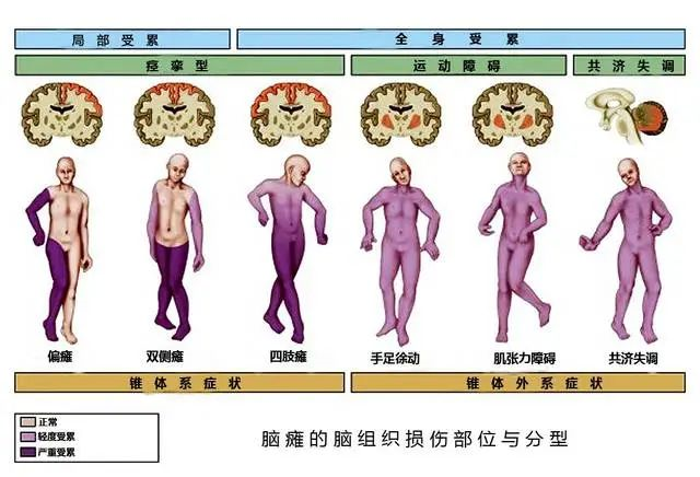 【科普】每一个脑瘫孩子都是折翼天使，让我们共同守护